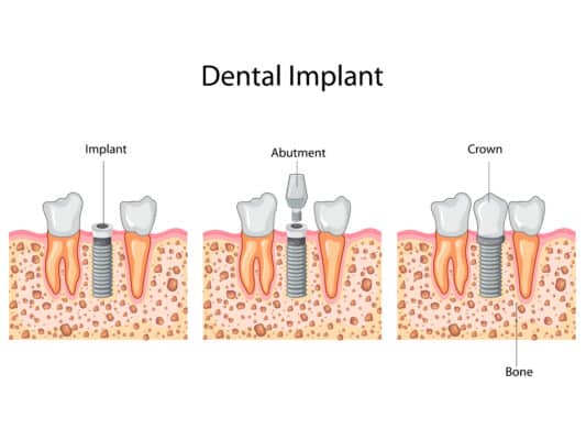 4 consejos para el postratamiento de coronas sobre implantes | Happy Smiles Family Dentist