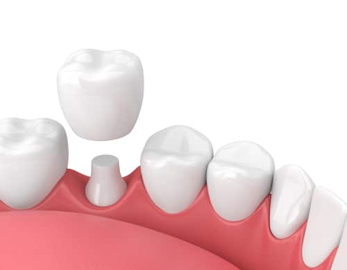 4 Tips For Taking Care of Your Dental Crowns | Happy Smiles