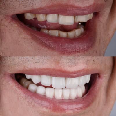 A Step-by-Step Guide After Your Smile Makeover | Happy Smiles