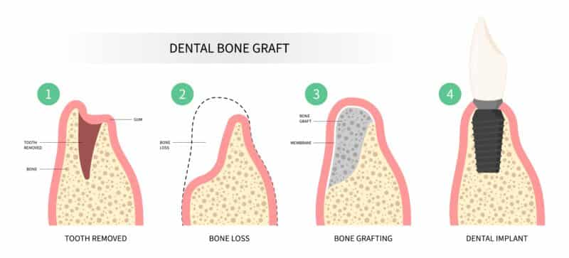 Bone Graft for Dental Implant Restoration | Happy Smiles Dentistry