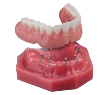 Dentaduras postizas en Schaumburg, IL | Dentadura postiza Snap-On soportada por implantes