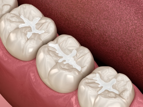 Encuentre un dentista para empastes dentales | Happy Smiles Family Dentistry
