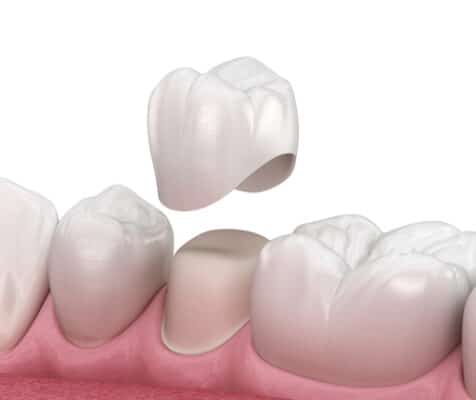 Soluciones de odontología general con coronas dentales | Sonrisas felices
