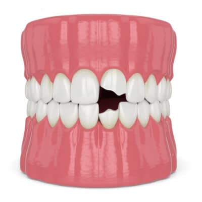 Odontología general Tratamientos para un diente dañado | Happy Smiles