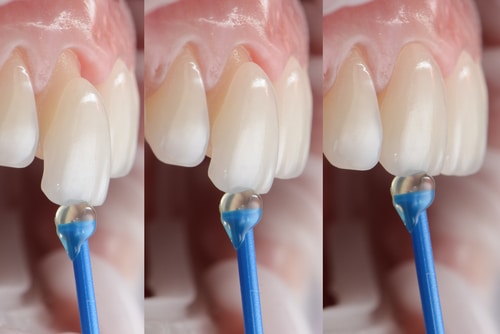 How Dental Veneers Are Used in General Dentistry | Happy Smiles