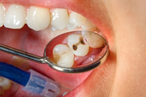 Cómo previene y trata la caries la odontología general | Sonrisas felices