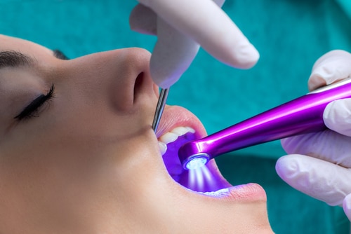 Cómo utiliza la odontología general los selladores dentales | Sonrisas felices