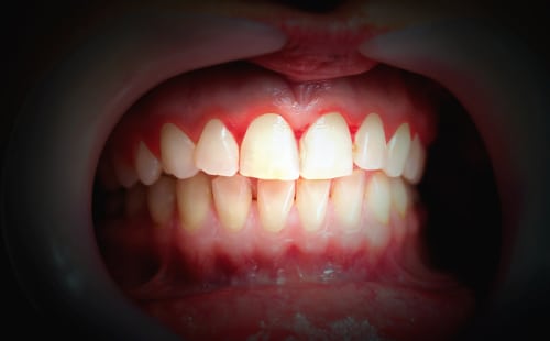 ¿Cómo trata un dentista general las enfermedades de las encías? | Sonrisas Felices