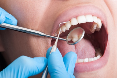 ¿Con qué frecuencia debe realizarse una limpieza dental en odontología general?