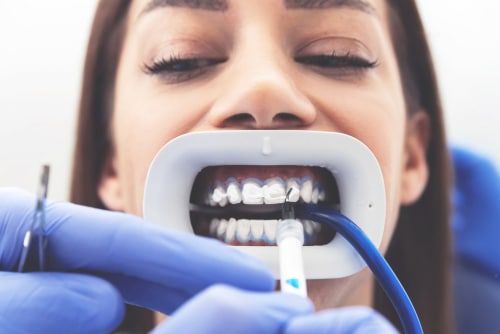 Cómo aliviar la sensibilidad al blanquear los dientes | Happy Smiles