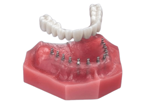Dentaduras postizas sobre implantes en Schaumburg, IL Dentaduras postizas Snap-On
