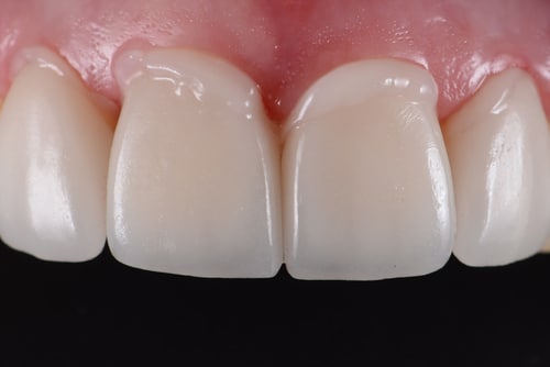 Tipos más comunes de tratamientos de adhesión dental | Happy Smiles