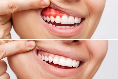 Consejos de odontología preventiva para las enfermedades de las encías | Happy Smiles Dentist
