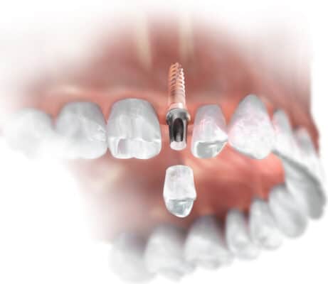 Opciones de reemplazo de un solo diente | Happy Smiles Family Dentistry