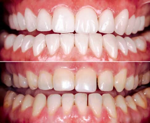 Tratamientos de blanqueamiento dental realizados por un dentista general