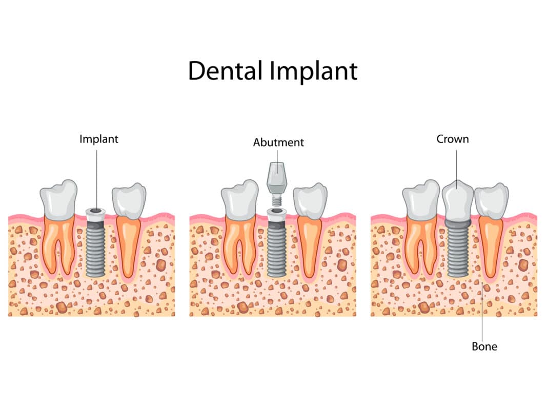 4 consejos para el postratamiento de coronas sobre implantes | Happy Smiles Family Dentist