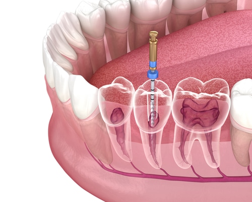 7 señales de que necesita cirugía endodóntica | Happy Smiles Dentistry