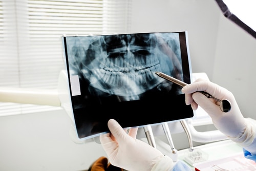 Are Dental X-rays Recommended? | Happy Smiles Family Dentistry