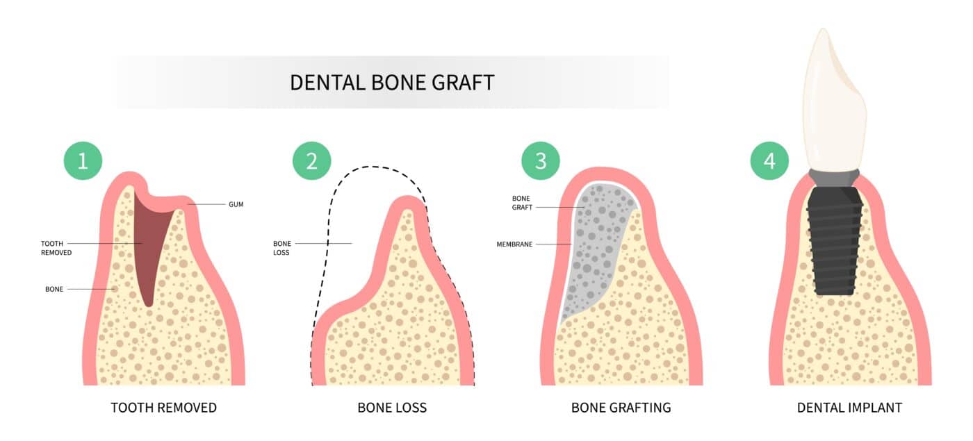 Bone Graft for Dental Implant Restoration | Happy Smiles Dentistry
