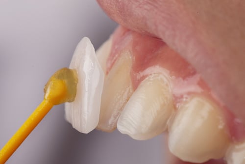 Can Dental Veneers Be Removed? | Happy Smiles Dentistry