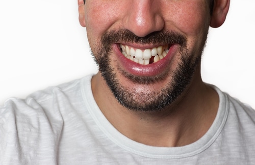 ¿Puede la odontología general reparar los dientes caídos? | Sonrisas Felices