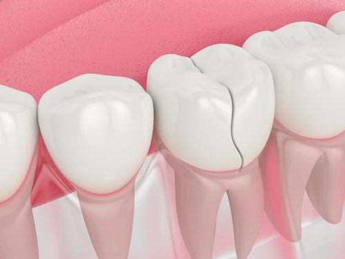 ¿Se puede salvar un diente agrietado con una endodoncia y una corona?