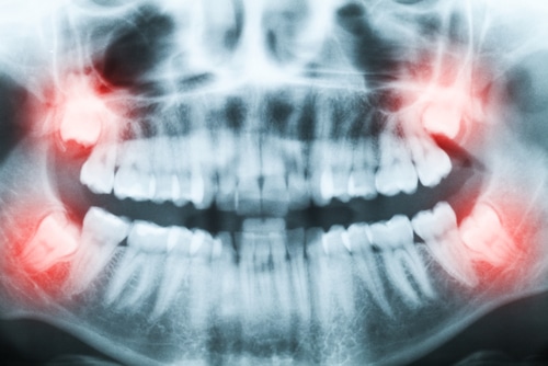 Commonly Asked Questions About Wisdom Tooth Extractions