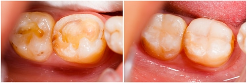 Empastes de Composite | Happy Smiles Family Dentistry | Schaumburg