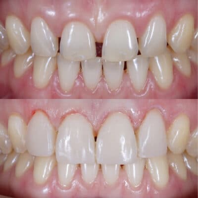Adhesión Dental | Happy Smiles Family Dentistry | Schaumburg, IL