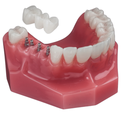 Dental Bridges in Schaumburg, IL Mini Dental Implant Bridge