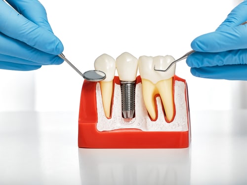 Restauración de implantes dentales | Happy Smiles Family Dentistry