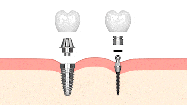 Dental Implants in Schaumburg, IL  Happy Smiles Family Dentistry
