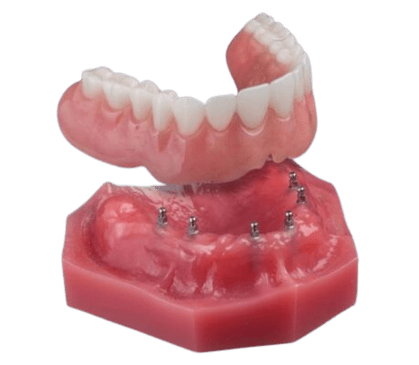 Dentures in Schaumburg, IL | Implant-Supported Snap-On Denture