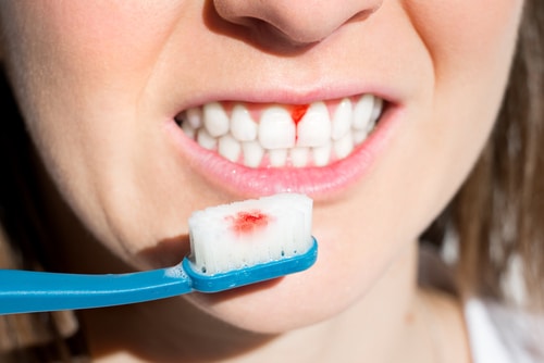 Odontología general Tratamientos para el sangrado de encías | Sonrisas Felices