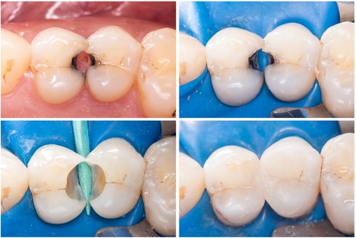 Cómo un empaste dental puede proteger sus dientes | Happy Smiles Dentist