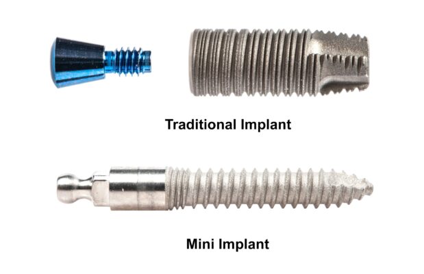 Mini Dental Implants in Schaumburg, IL Mini Implant Dentist