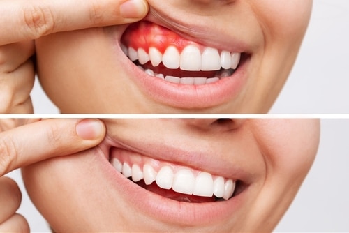 Preventive Dentistry Tips for Gum Disease | Happy Smiles Dentist