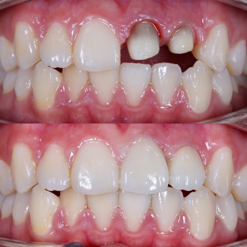 Replacing a Worn-Out Dental Filling With a Crown | Happy Smiles