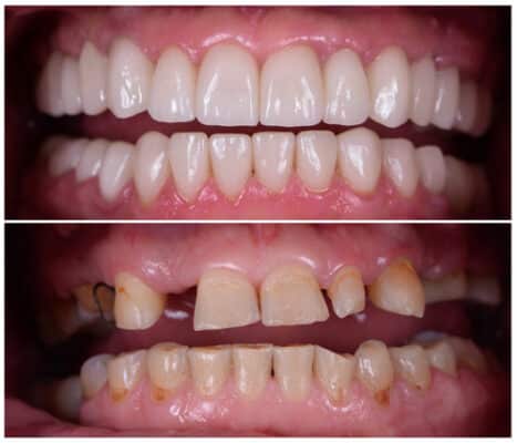 Smile Makeover in Schaumburg, IL Happy Smiles Family Dentistry