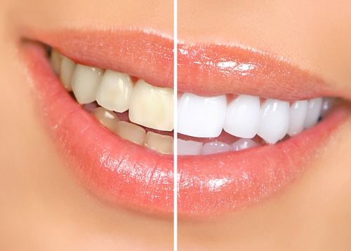 Teeth Whitening in Schaumburg, IL Teeth Bleaching Treatments