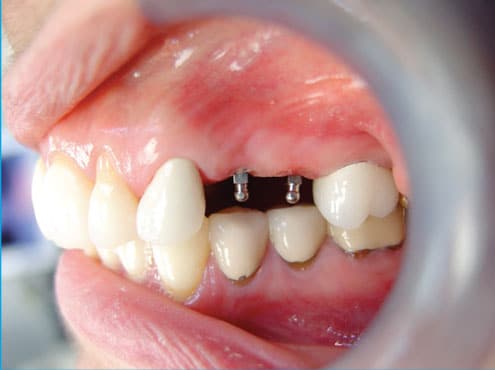 Dentista de Implantes en Schaumburg, IL Happy Smiles Family Dentistry
