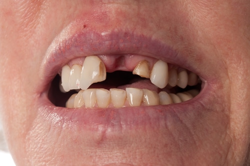 Opciones de reemplazo de múltiples dientes Dra. Amelia Aristodemo