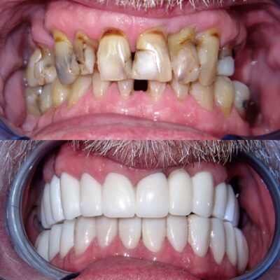 Options for Replacing All of My Teeth Dr. Amelia Aristodemo