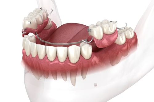 Dentadura parcial para un diente que falta Dr. Amelia Aristodemo