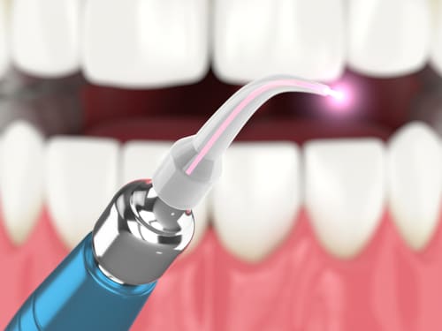Odontología láser de tejidos blandos Happy Smiles Family Dentistry
