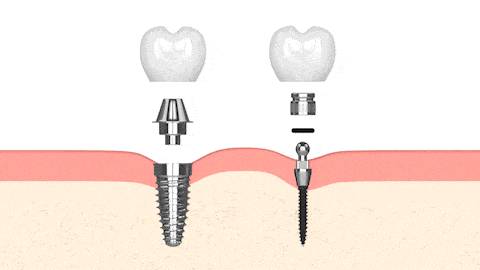 Diferencia entre implantes dentales y miniimplantes dentales