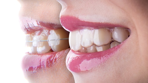 Which Is Better Invisalign or Braces Dr. Amelia Aristodemo