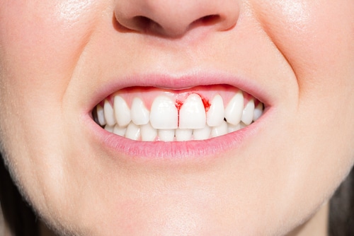 Why Are My Gums Bleeding Periodontics in Schaumburg, IL
