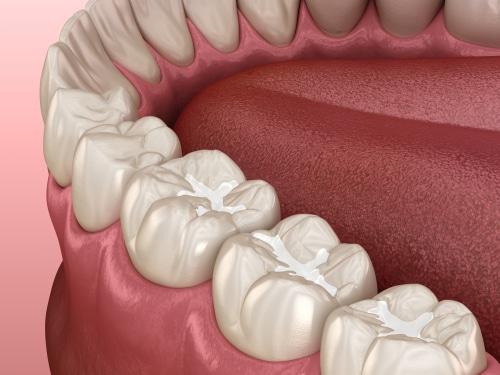 Por qué son importantes los selladores dentales para proteger los dientes de su hijo
