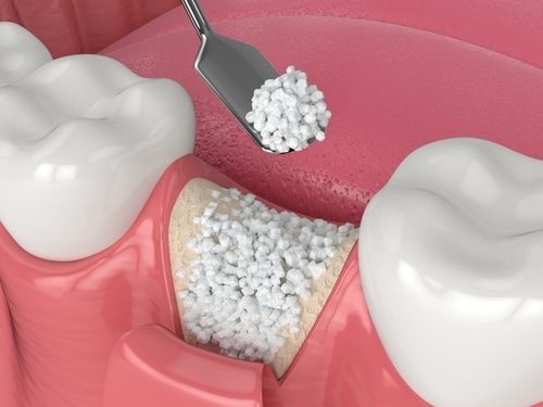 Will I Need a Bone Graft for Dental Implants